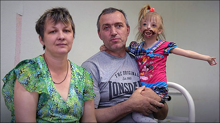 Fighting stigma: parents of girl born with half a face tell of their battle to help her