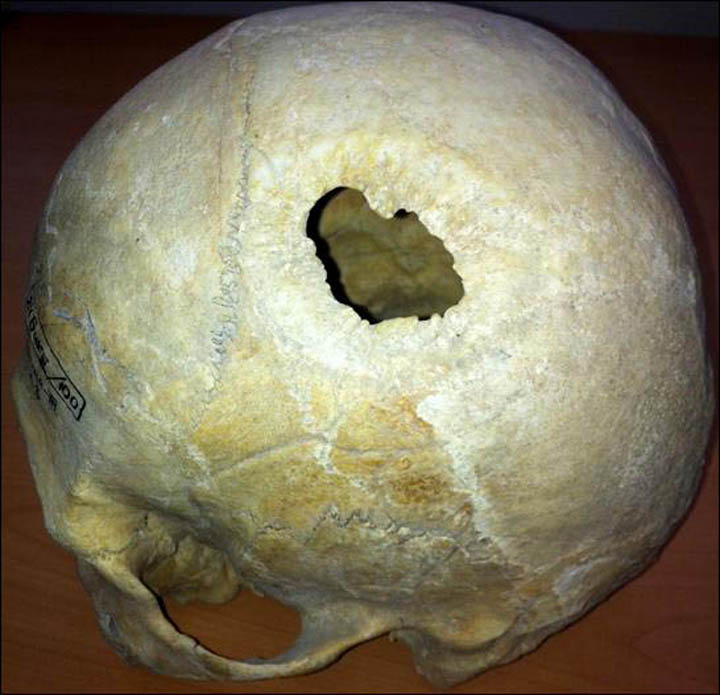 Man scull with trepanation from Bike-III