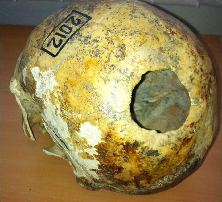 Scull of a man with traces of trepanation in Kyzyl-Dzhar