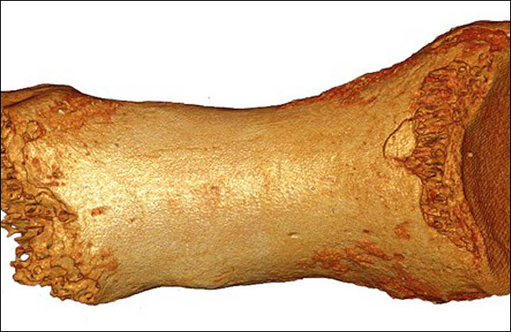Separate DNA analysis of the remains of a 50,000 year old girl's finger from the Altai cave earlier revealed the identity of a new type of human in 2010 - 'the Denisovans', closely related to the Neanderthals.
