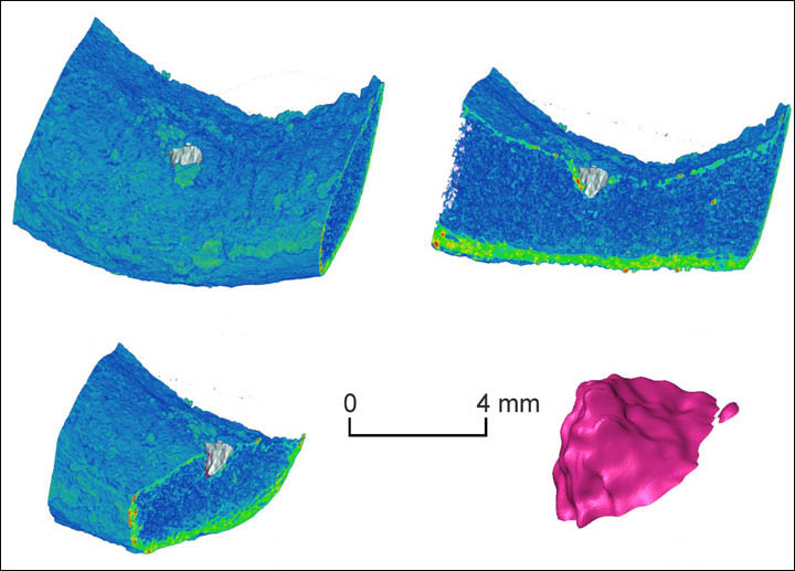 3D model of the injury