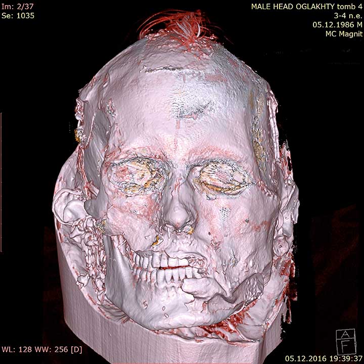 CT scan