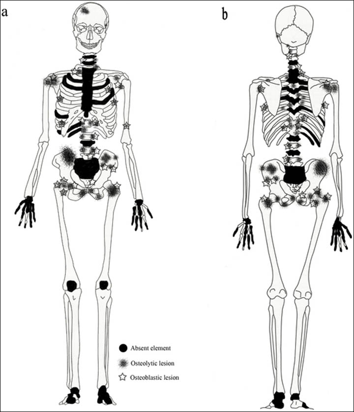 Sceme of cancer changes